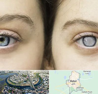 متخصص آب سیاه (گلوکوم) در بابل