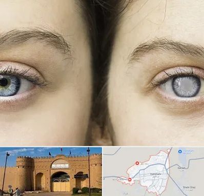 متخصص آب سیاه (گلوکوم) در ایرانشهر