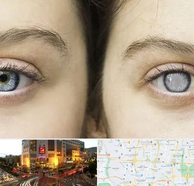 متخصص آب سیاه (گلوکوم) در جنت آباد تهران 