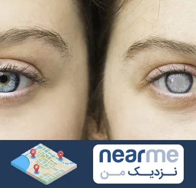 متخصص آب سیاه (گلوکوم) در نزدیک من