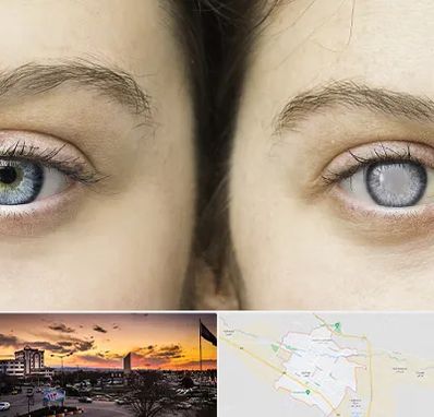 متخصص آب سیاه (گلوکوم) در قوچان