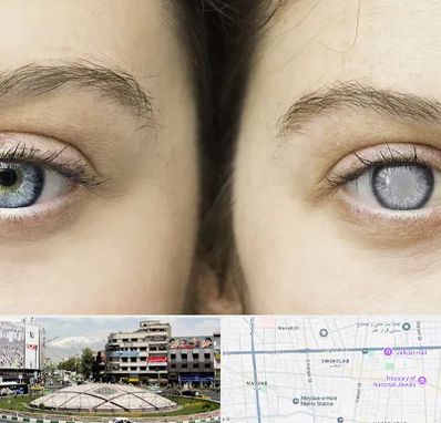 متخصص آب سیاه (گلوکوم) در مرکز تهران