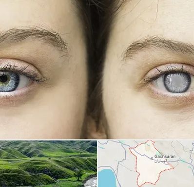 متخصص آب سیاه (گلوکوم) در گچساران