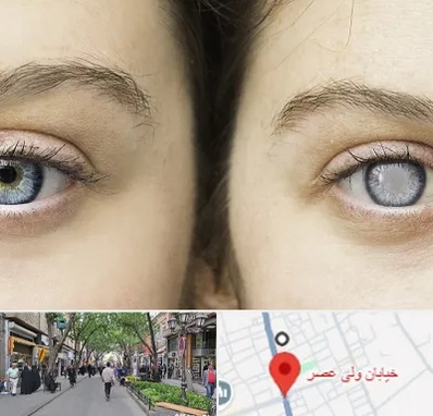 متخصص آب سیاه (گلوکوم) در ولیعصر شهریار