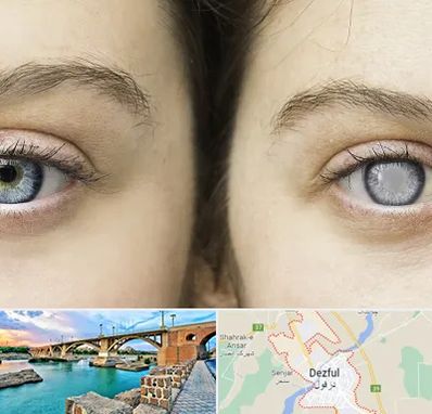 متخصص آب سیاه (گلوکوم) در دزفول