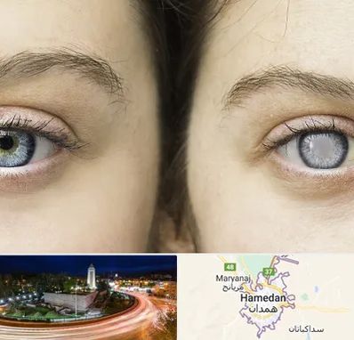 متخصص آب سیاه (گلوکوم) در همدان