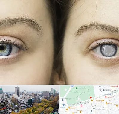 متخصص آب سیاه (گلوکوم) در بلوار کشاورز 