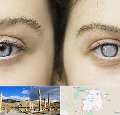 متخصص آب سیاه (گلوکوم) در مرودشت