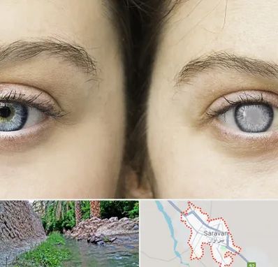 متخصص آب سیاه (گلوکوم) در سراوان