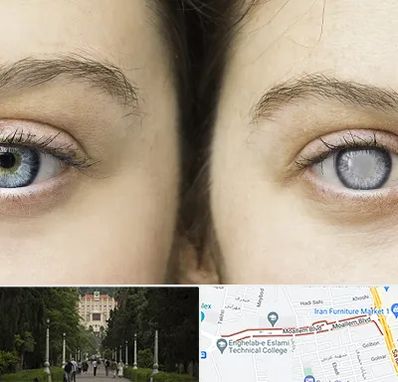 متخصص آب سیاه (گلوکوم) در بلوار معلم رشت 