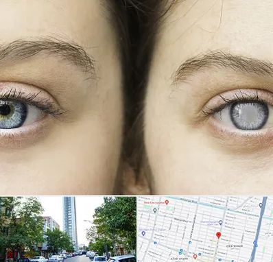 متخصص آب سیاه (گلوکوم) در امامت مشهد