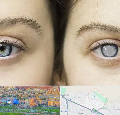 متخصص آب سیاه (گلوکوم) در رشدیه تبریز