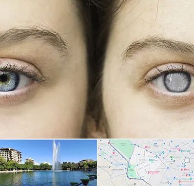 متخصص آب سیاه (گلوکوم) در کوهسنگی مشهد