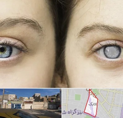 متخصص آب سیاه (گلوکوم) در اتابک