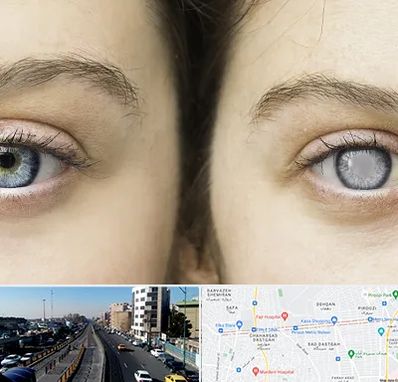 متخصص آب سیاه (گلوکوم) در پیروزی 