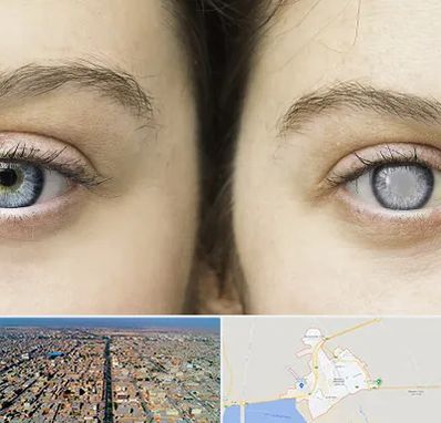 متخصص آب سیاه (گلوکوم) در بندر ماهشهر