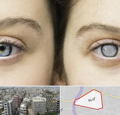 متخصص آب سیاه (گلوکوم) در آذری