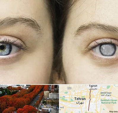 متخصص آب سیاه (گلوکوم) در ولیعصر 