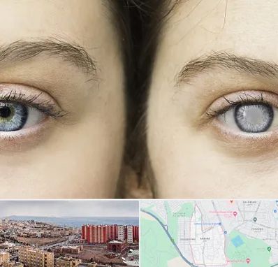 متخصص آب سیاه (گلوکوم) در سهند تبریز