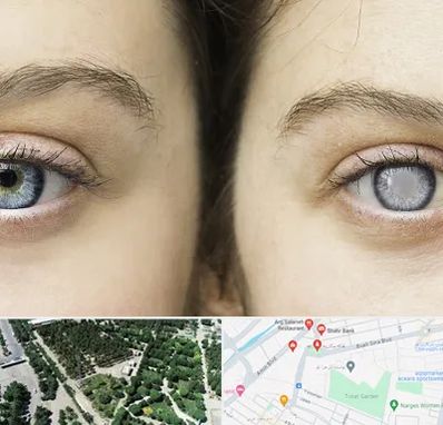 متخصص آب سیاه (گلوکوم) در سالاریه قم