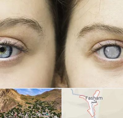 متخصص آب سیاه (گلوکوم) در فشم