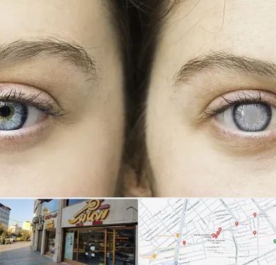 متخصص آب سیاه (گلوکوم) در عطاران قم