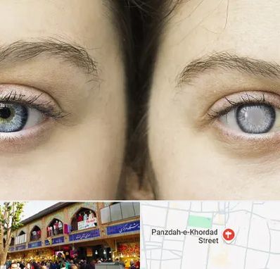 متخصص آب سیاه (گلوکوم) در 15 خرداد