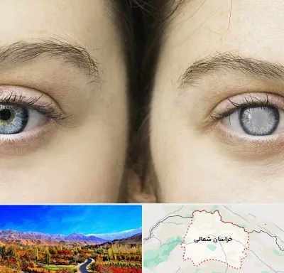 متخصص آب سیاه (گلوکوم) در خراسان شمالی