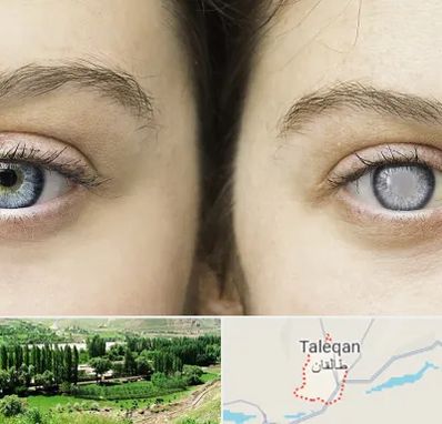 متخصص آب سیاه (گلوکوم) در طالقان