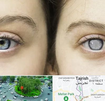 متخصص آب سیاه (گلوکوم) در تجریش 