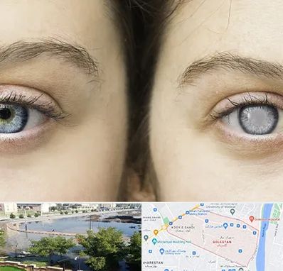 متخصص آب سیاه (گلوکوم) در گلستان اهواز