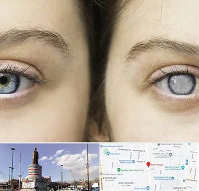 متخصص آب سیاه (گلوکوم) در کارگر جنوبی 