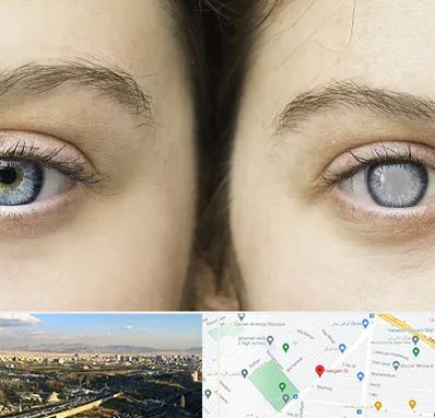 متخصص آب سیاه (گلوکوم) در هنگام 