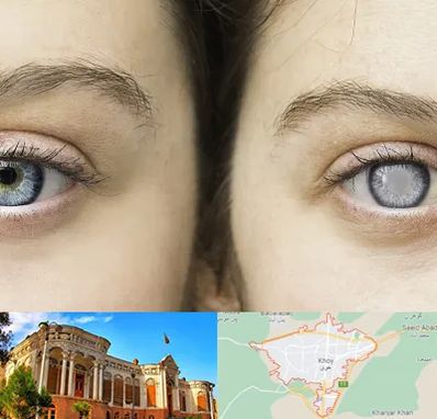 متخصص آب سیاه (گلوکوم) در خوی