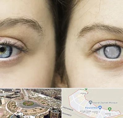 متخصص آب سیاه (گلوکوم) در پرند