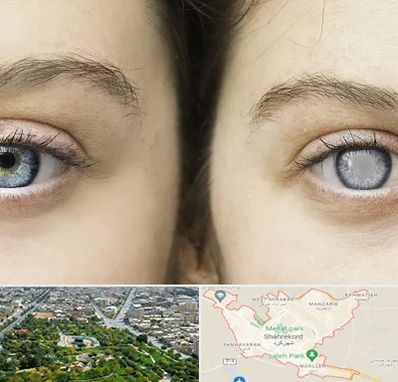 متخصص آب سیاه (گلوکوم) در شهرکرد