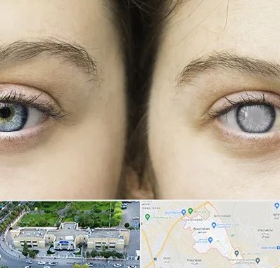 متخصص آب سیاه (گلوکوم) در نسیم شهر