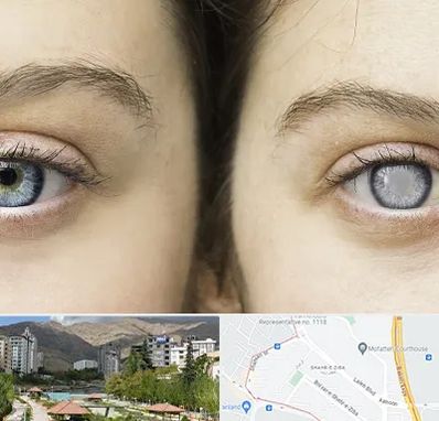 متخصص آب سیاه (گلوکوم) در شهر زیبا 