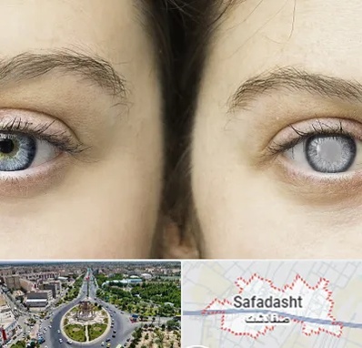 متخصص آب سیاه (گلوکوم) در صفادشت