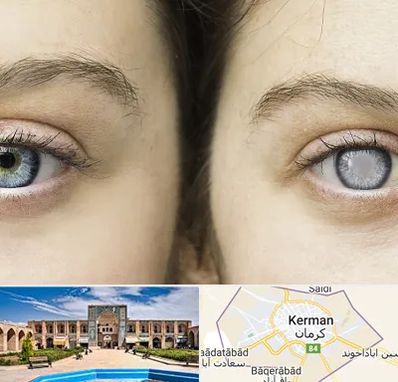 متخصص آب سیاه (گلوکوم) در کرمان
