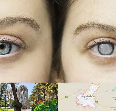 متخصص آب سیاه (گلوکوم) در نیشابور