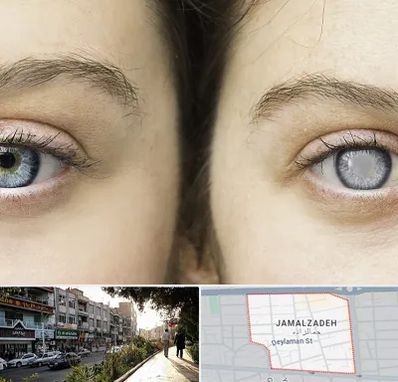 متخصص آب سیاه (گلوکوم) در خیابان جمالزاده