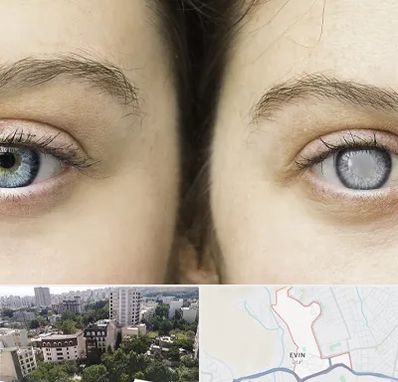 متخصص آب سیاه (گلوکوم) در اوین