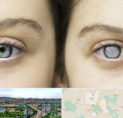 متخصص آب سیاه (گلوکوم) در شهریار