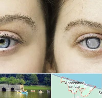 متخصص آب سیاه (گلوکوم) در عباس آباد