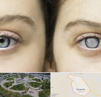 متخصص آب سیاه (گلوکوم) در ورامین