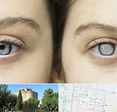 متخصص آب سیاه (گلوکوم) در مرداویج اصفهان