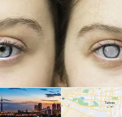 متخصص آب سیاه (گلوکوم) در غرب تهران 