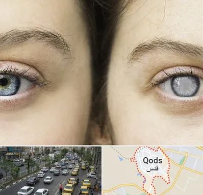 متخصص آب سیاه (گلوکوم) در شهر قدس
