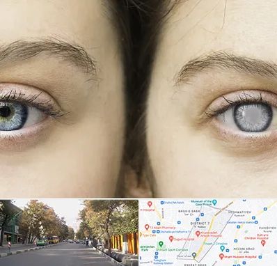 متخصص آب سیاه (گلوکوم) در شریعتی 